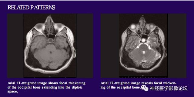 Skull Thickness Skull Thickness