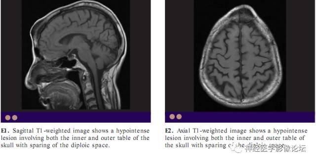 Skull Thickness Skull Thickness