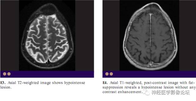 Skull Thickness Skull Thickness