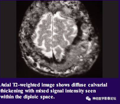 Skull Thickness Skull Thickness