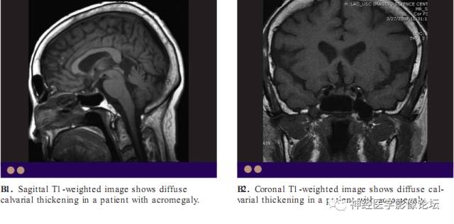 Skull Thickness Skull Thickness