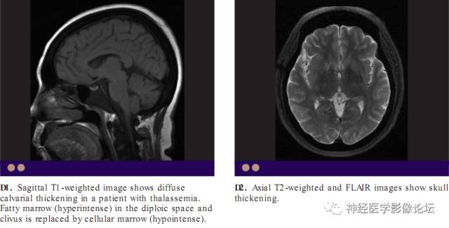 Skull Thickness Skull Thickness