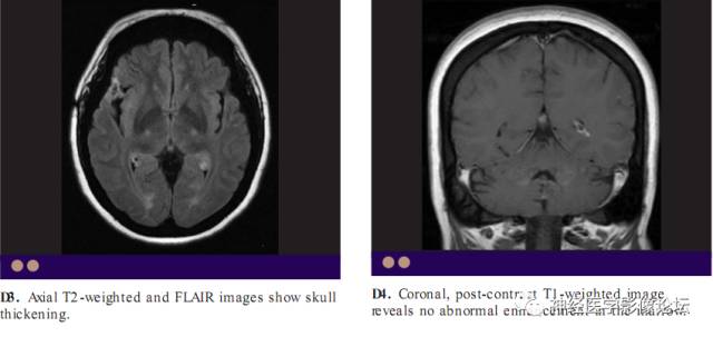 Skull Thickness Skull Thickness
