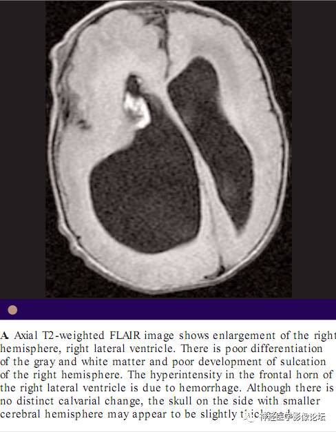 Skull Thickness Skull Thickness