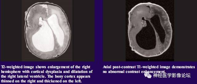 Skull Thickness Skull Thickness