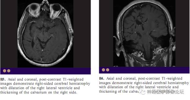 Skull Thickness Skull Thickness
