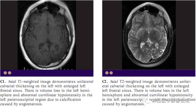 Skull Thickness Skull Thickness