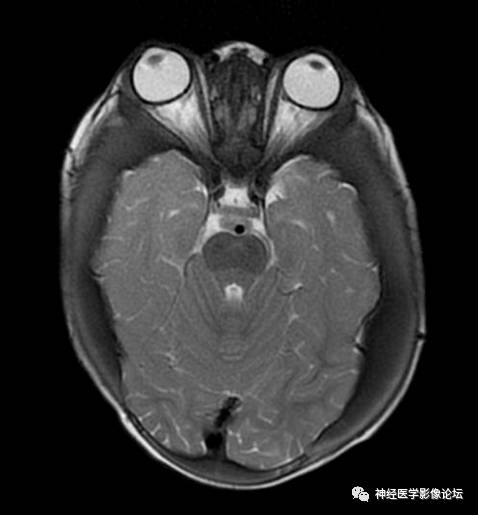 Skull Thickness Skull Thickness