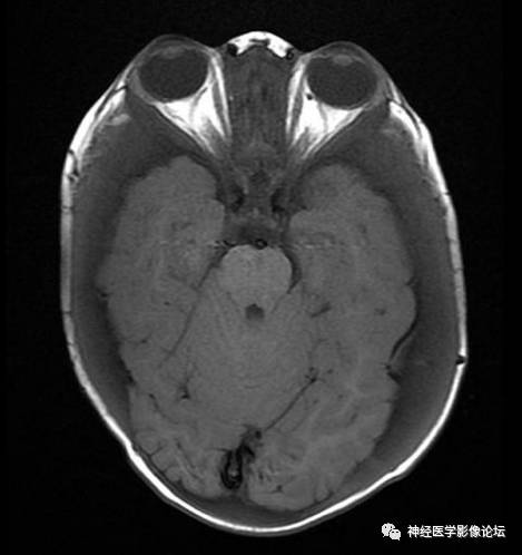Skull Thickness Skull Thickness