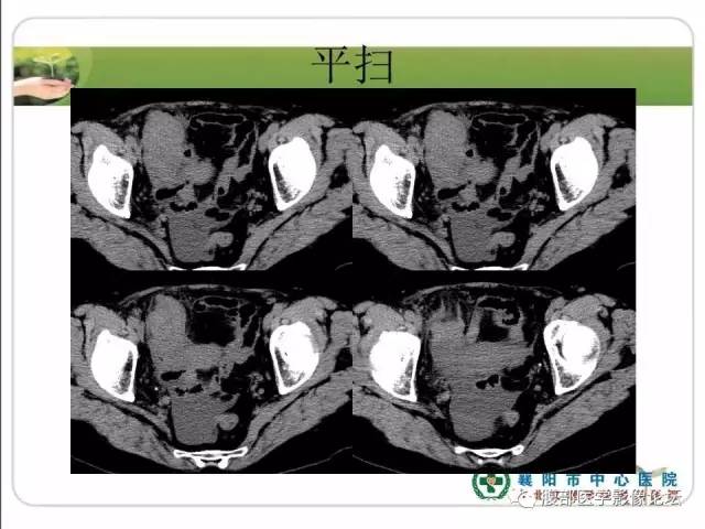 【病例】右侧卵巢囊性畸胎瘤恶变1例CT影像表现 【病例】右侧卵巢囊性畸胎瘤恶变1例CT影像表现