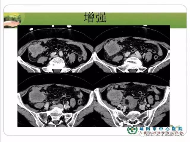 【病例】右侧卵巢囊性畸胎瘤恶变1例CT影像表现 【病例】右侧卵巢囊性畸胎瘤恶变1例CT影像表现