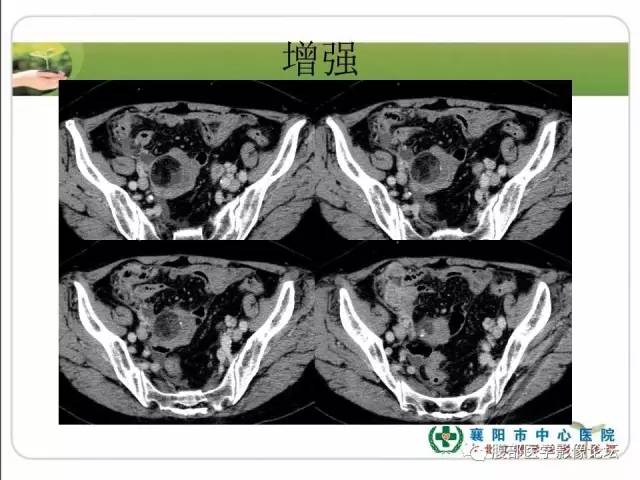 【病例】右侧卵巢囊性畸胎瘤恶变1例CT影像表现 【病例】右侧卵巢囊性畸胎瘤恶变1例CT影像表现