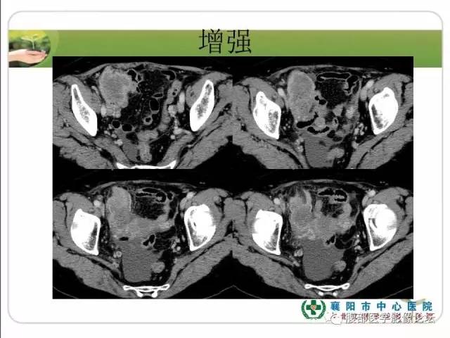 【病例】右侧卵巢囊性畸胎瘤恶变1例CT影像表现 【病例】右侧卵巢囊性畸胎瘤恶变1例CT影像表现