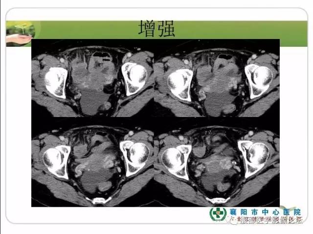 【病例】右侧卵巢囊性畸胎瘤恶变1例CT影像表现 【病例】右侧卵巢囊性畸胎瘤恶变1例CT影像表现