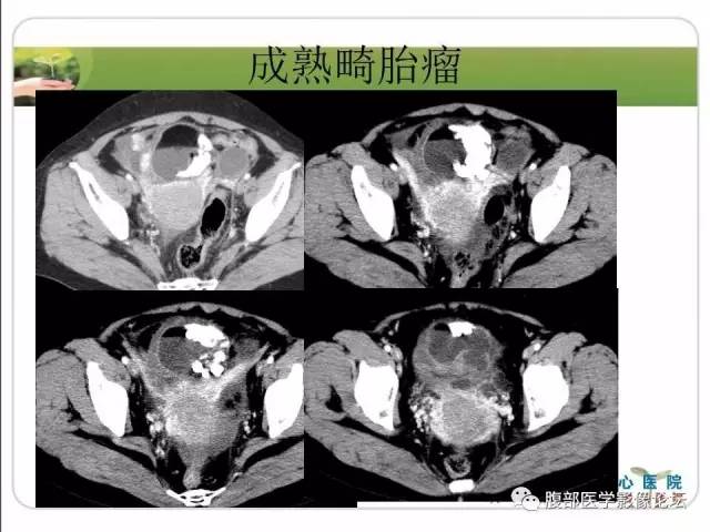 【病例】右侧卵巢囊性畸胎瘤恶变1例CT影像表现 【病例】右侧卵巢囊性畸胎瘤恶变1例CT影像表现