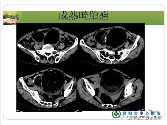 【病例】右侧卵巢囊性畸胎瘤恶变1例CT影像表现 【病例】右侧卵巢囊性畸胎瘤恶变1例CT影像表现
