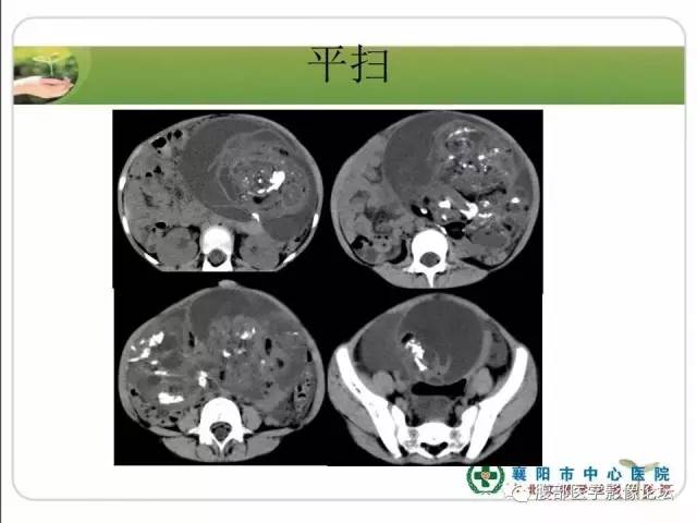 【病例】右侧卵巢囊性畸胎瘤恶变1例CT影像表现 【病例】右侧卵巢囊性畸胎瘤恶变1例CT影像表现