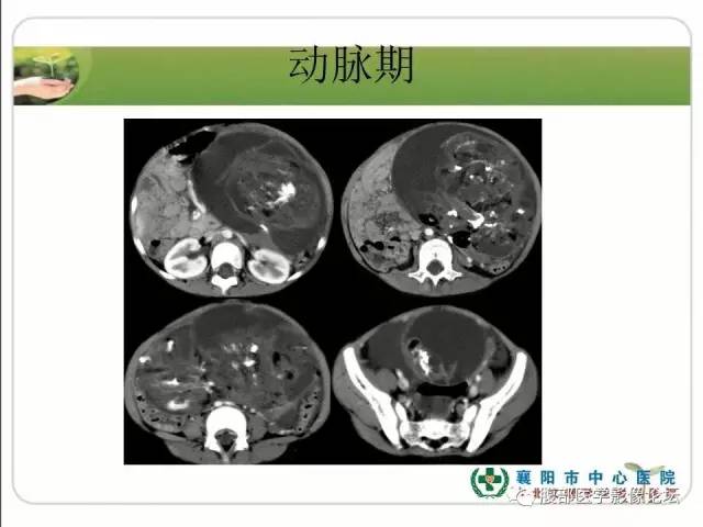 【病例】右侧卵巢囊性畸胎瘤恶变1例CT影像表现 【病例】右侧卵巢囊性畸胎瘤恶变1例CT影像表现