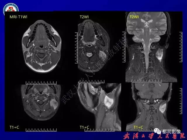 【病例】颈部韧带样纤维瘤病1例影像诊断