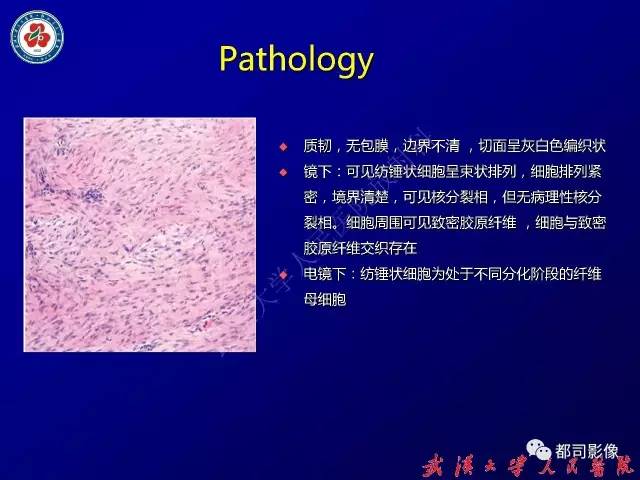 【病例】颈部韧带样纤维瘤病1例影像诊断