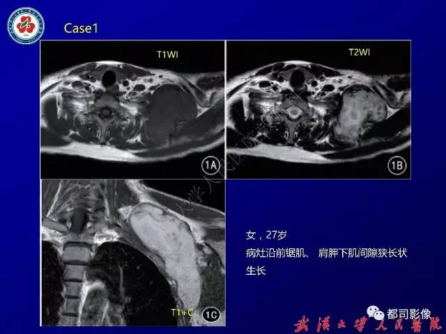【病例】颈部韧带样纤维瘤病1例影像诊断