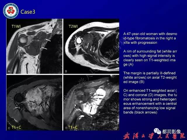 【病例】颈部韧带样纤维瘤病1例影像诊断