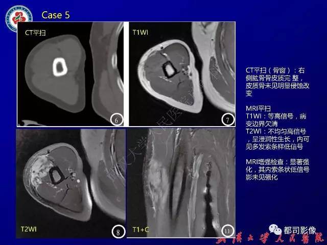 【病例】颈部韧带样纤维瘤病1例影像诊断