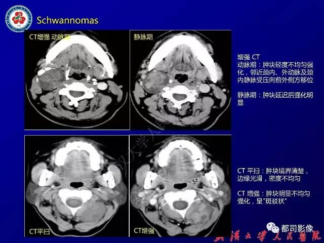 【病例】颈部韧带样纤维瘤病1例影像诊断