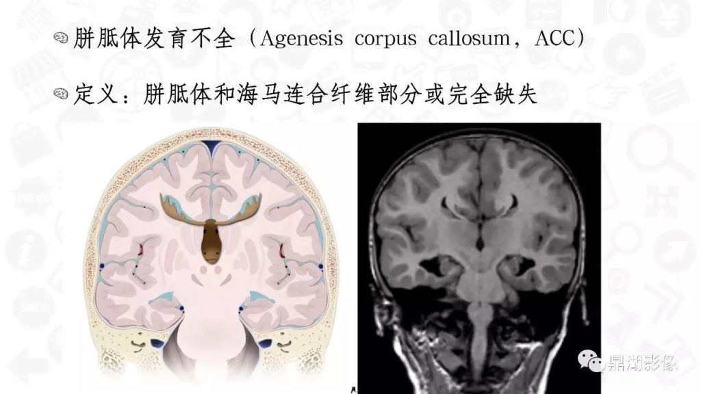 【PPT】胼胝体发育不全