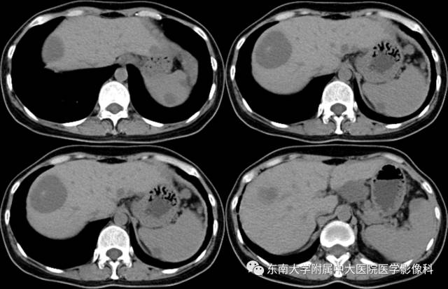 【病例】肝脏囊性转移瘤1例CT