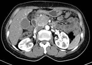 【病例】自身免疫性胰腺炎1例CT影像表现