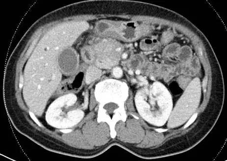 【病例】自身免疫性胰腺炎1例CT影像表现 【病例】自身免疫性胰腺炎1例CT影像表现