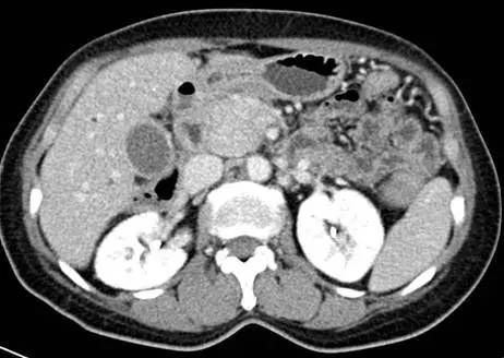 【病例】自身免疫性胰腺炎1例CT影像表现 【病例】自身免疫性胰腺炎1例CT影像表现