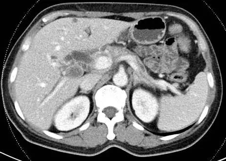 【病例】自身免疫性胰腺炎1例CT影像表现 【病例】自身免疫性胰腺炎1例CT影像表现