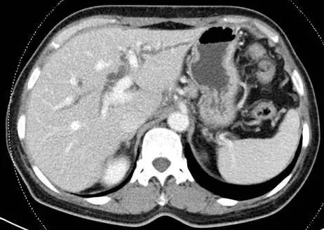 【病例】自身免疫性胰腺炎1例CT影像表现 【病例】自身免疫性胰腺炎1例CT影像表现