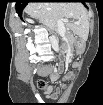 【病例】自身免疫性胰腺炎1例CT影像表现 【病例】自身免疫性胰腺炎1例CT影像表现