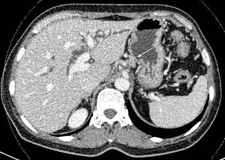 【病例】自身免疫性胰腺炎1例CT影像表现 【病例】自身免疫性胰腺炎1例CT影像表现