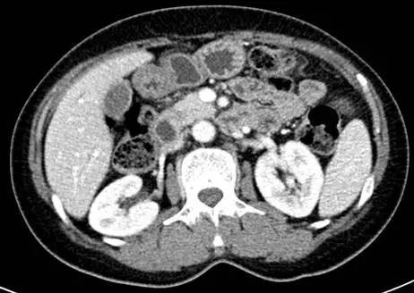 【病例】自身免疫性胰腺炎1例CT影像表现 【病例】自身免疫性胰腺炎1例CT影像表现