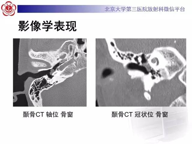 【病例】鼓室副神经节瘤2例CT及MR