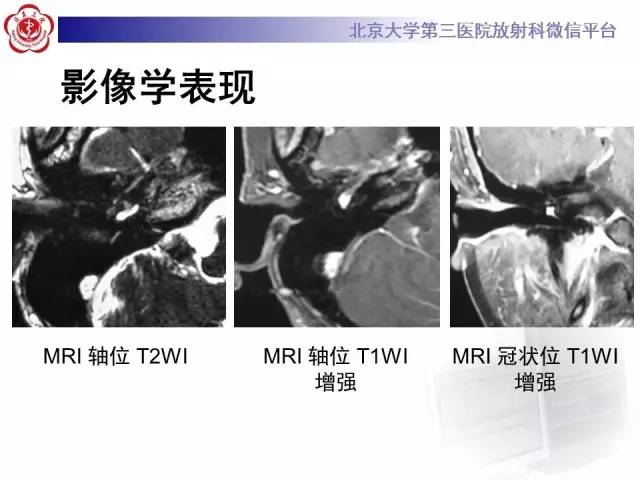 【病例】鼓室副神经节瘤2例CT及MR