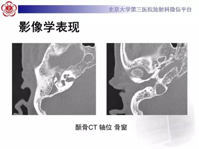 【病例】鼓室副神经节瘤2例CT及MR
