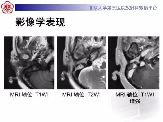 【病例】鼓室副神经节瘤2例CT及MR