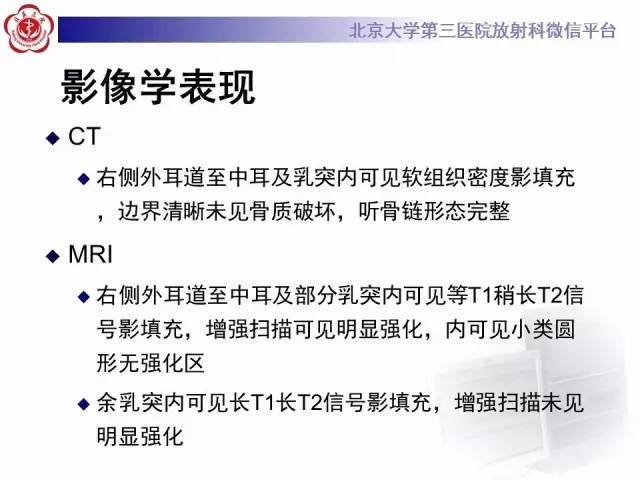 【病例】鼓室副神经节瘤2例CT及MR