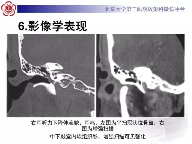 【病例】鼓室副神经节瘤2例CT及MR