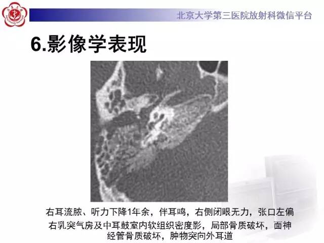 【病例】鼓室副神经节瘤2例CT及MR