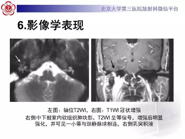 【病例】鼓室副神经节瘤2例CT及MR