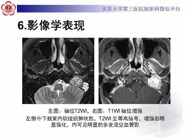 【病例】鼓室副神经节瘤2例CT及MR