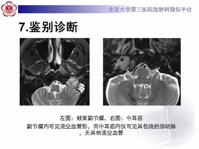 【病例】鼓室副神经节瘤2例CT及MR