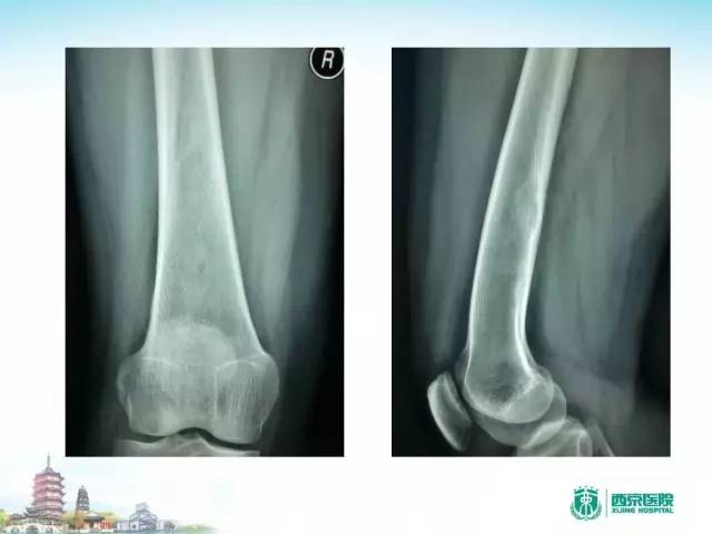 【PPT】骨肉瘤的影像诊断