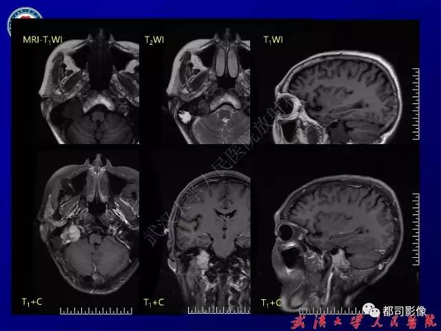 【病例】颞骨巨细胞修复性肉芽肿1例CT及MR影像诊断